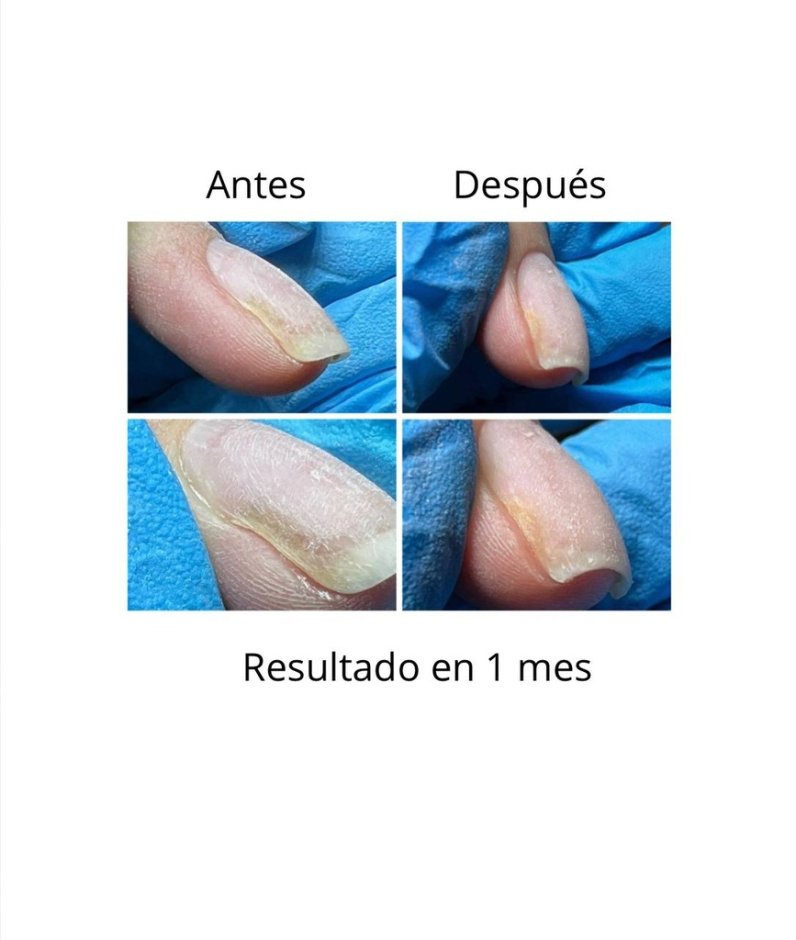 NAILSOFTHEDAY ONISTOP , aceite regenador para uñas con onicolisis, 15 ml — Photo 4