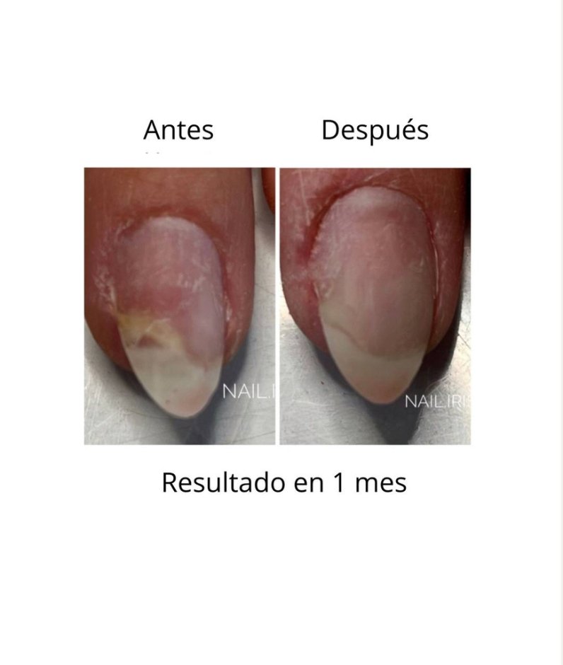 NAILSOFTHEDAY ONISTOP , aceite regenador para uñas con onicolisis, 8 ml — Photo 7