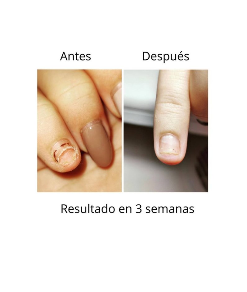 NAILSOFTHEDAY ONISTOP , aceite regenador para uñas con onicolisis, 8 ml — Photo 4