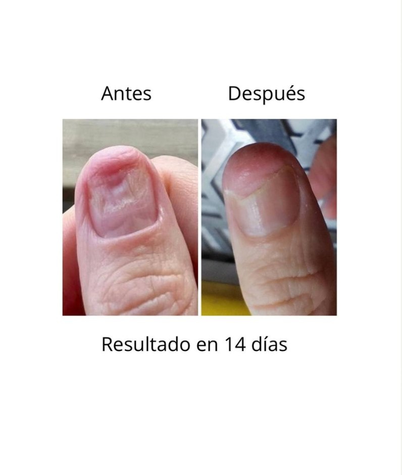 NAILSOFTHEDAY ONISTOP , aceite regenador para uñas con onicolisis, 15 ml — Photo 6