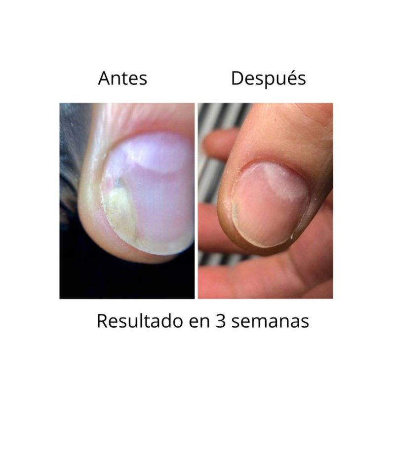 NAILSOFTHEDAY ONISTOP , aceite regenador para uñas con onicolisis, 8 ml — Photo 5