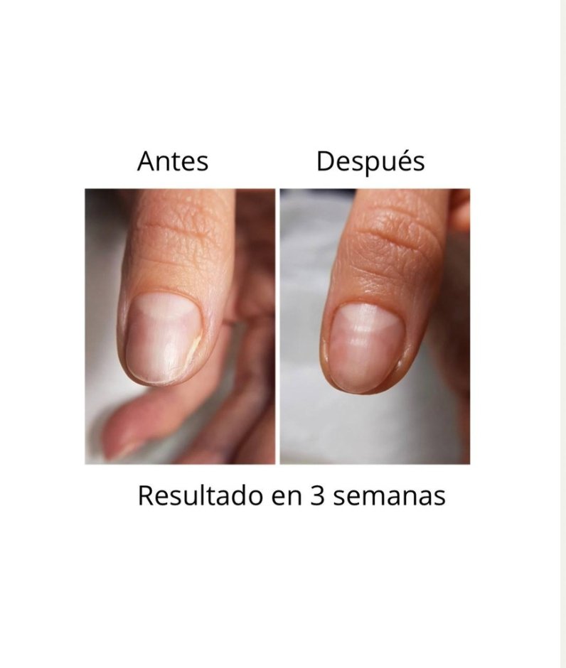 NAILSOFTHEDAY ONISTOP , aceite regenador para uñas con onicolisis, 8 ml — Photo 3