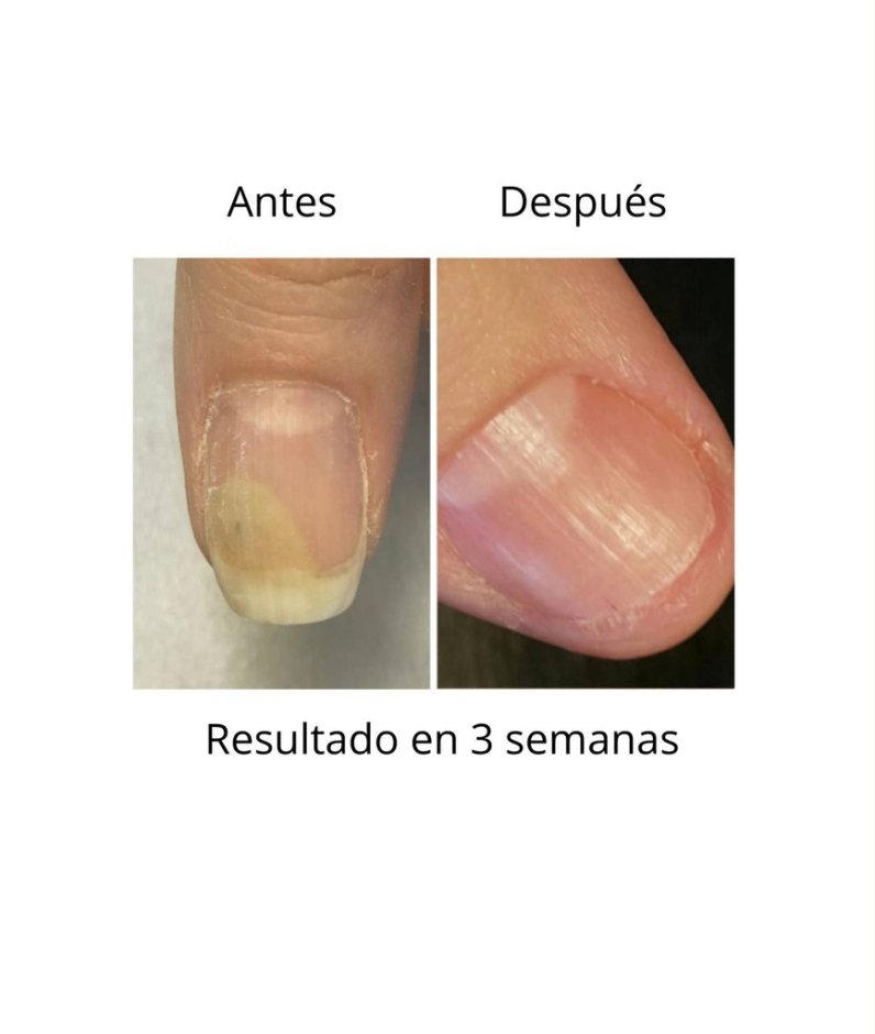 NAILSOFTHEDAY ONISTOP , aceite regenador para uñas con onicolisis, 15 ml — Photo 5