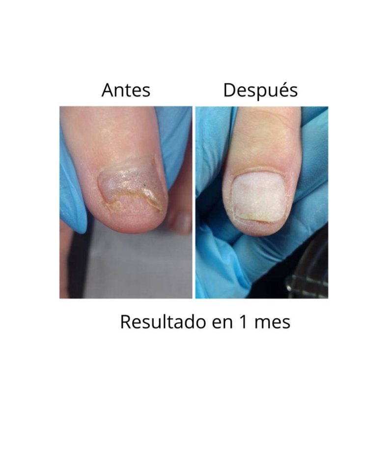 NAILSOFTHEDAY ONISTOP , aceite regenador para uñas con onicolisis, 15 ml — Photo 3