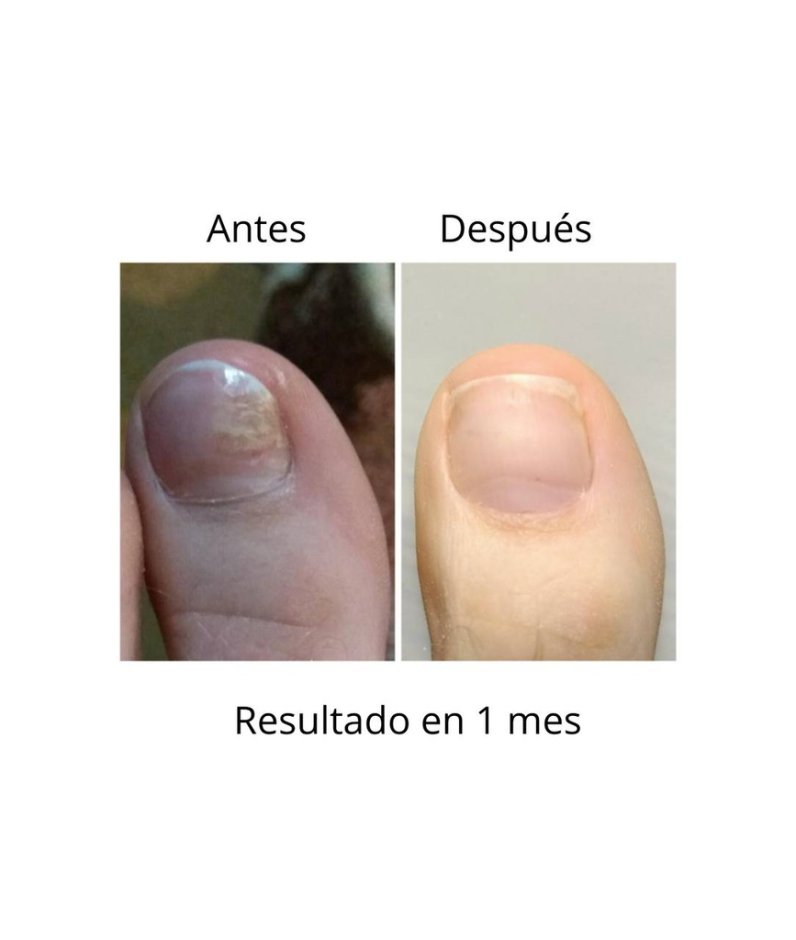 NAILSOFTHEDAY ONISTOP , aceite regenador para uñas con onicolisis, 8 ml — Photo 6