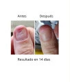 NAILSOFTHEDAY ONISTOP , aceite regenador para uñas con onicolisis, 15 ml — Photo 11